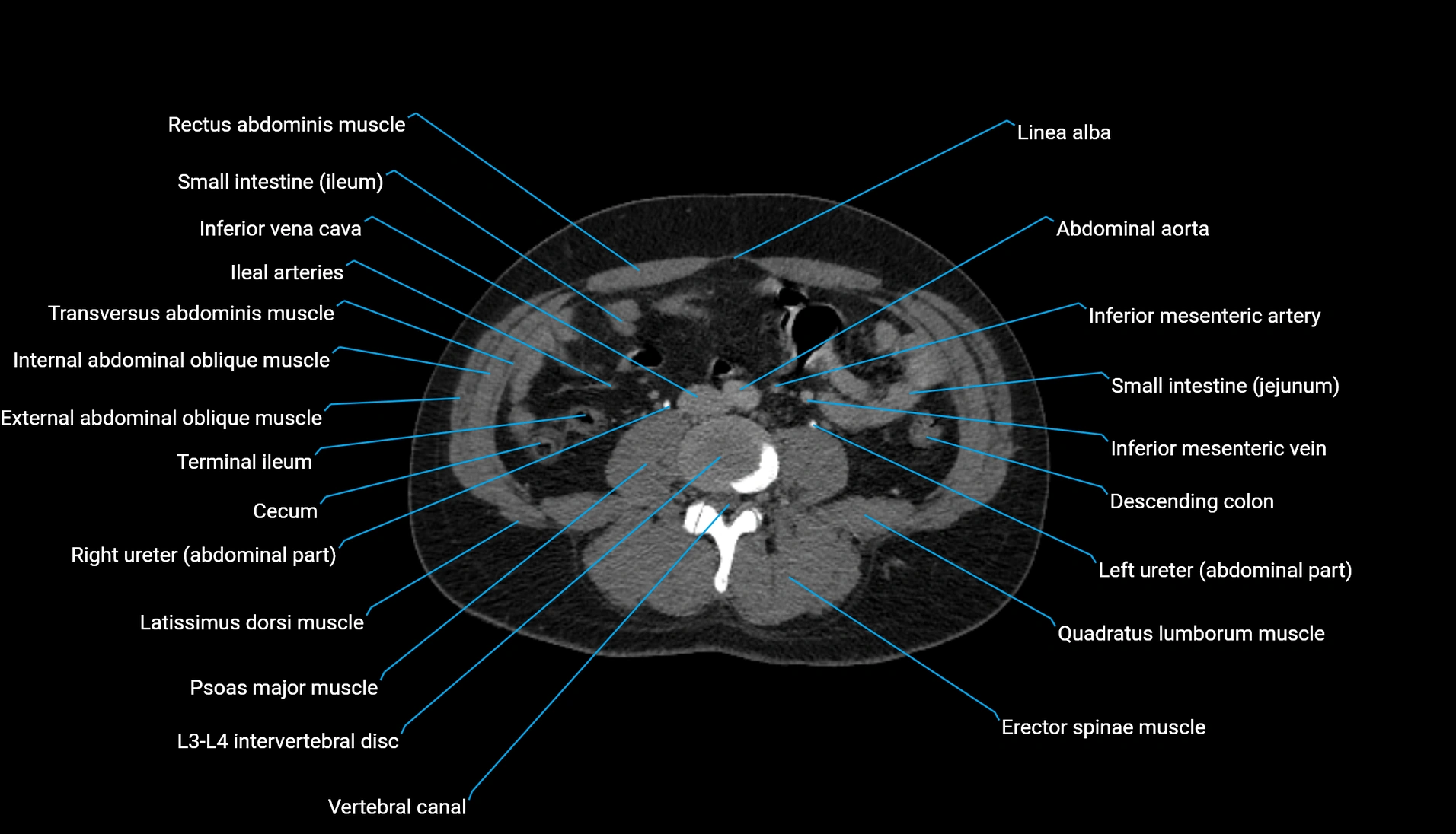 CT urogram axial cross sectional anatomy  labelled radiology image-00142.webp